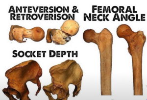 Variationer af anteversion og retroversion af hofteleddet